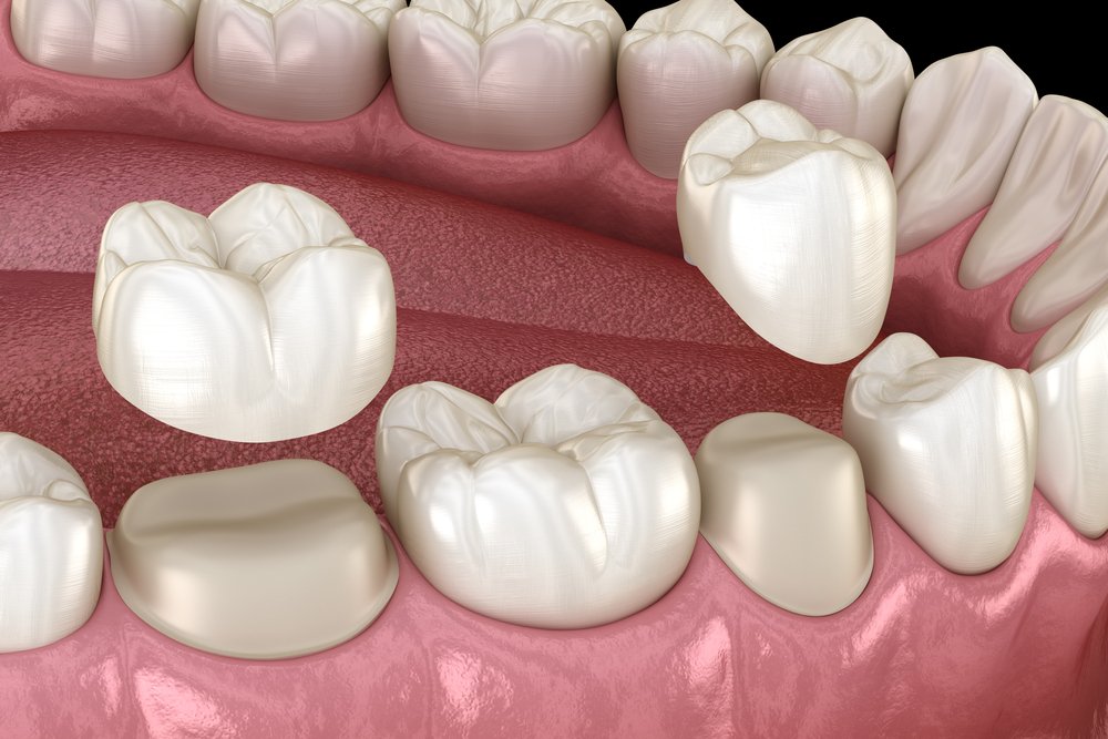 Dental Crown in Meerut