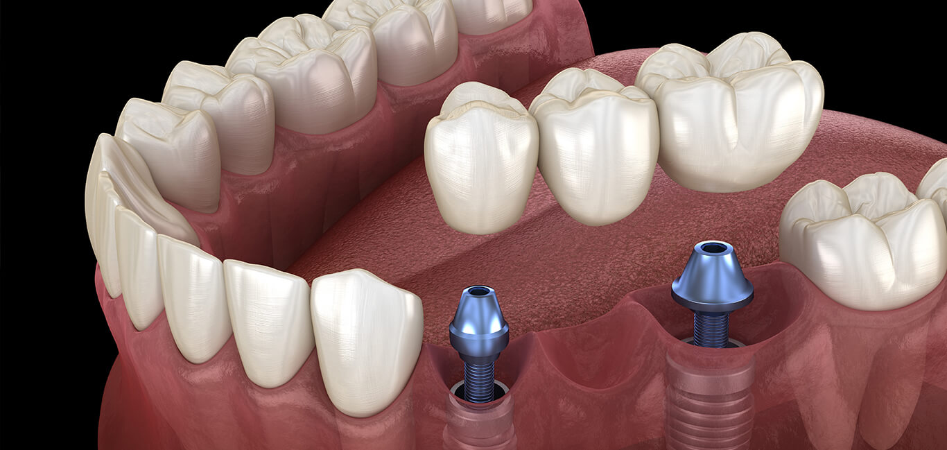 Dental Implant in Meerut