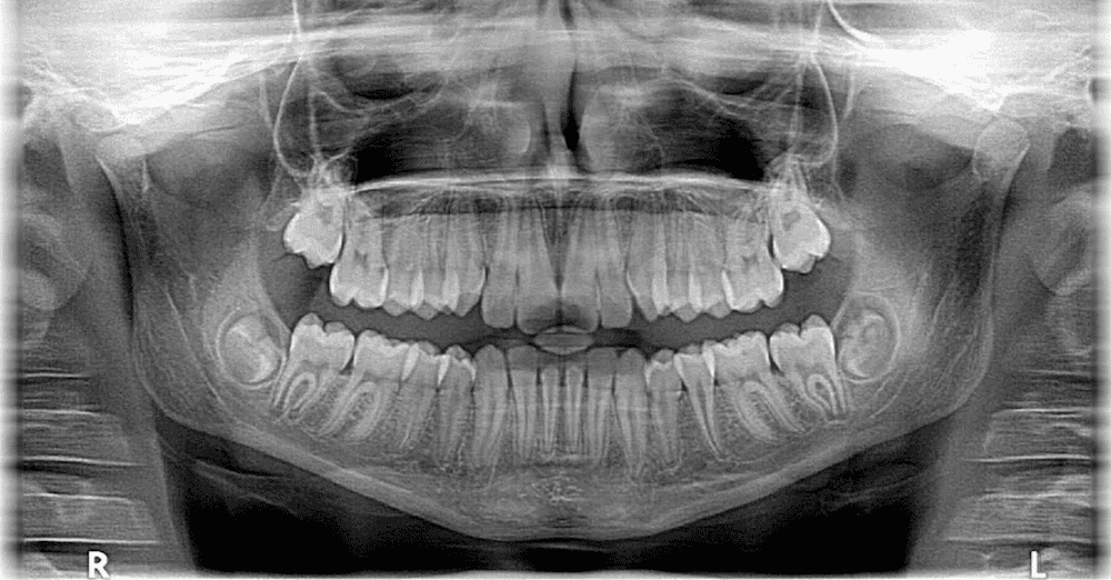 Dental X-rays In Meerut