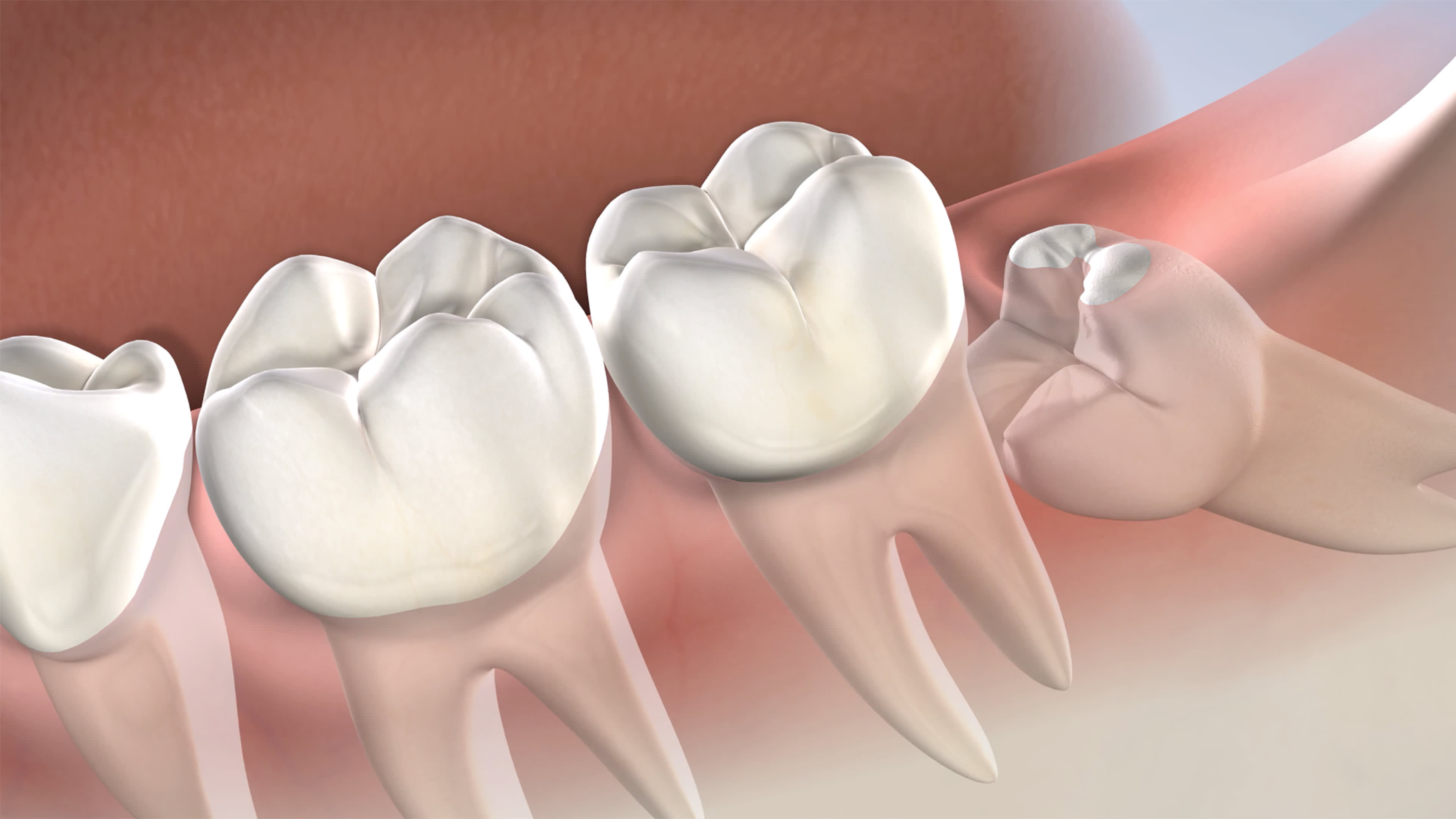 Wisdom Teeth Extraction in Meerut